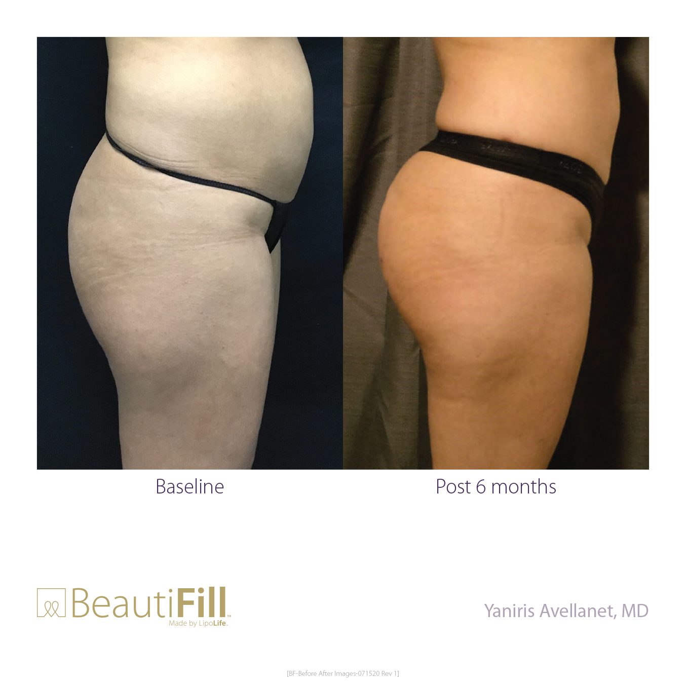 BeautiFill Before and After B2B 23