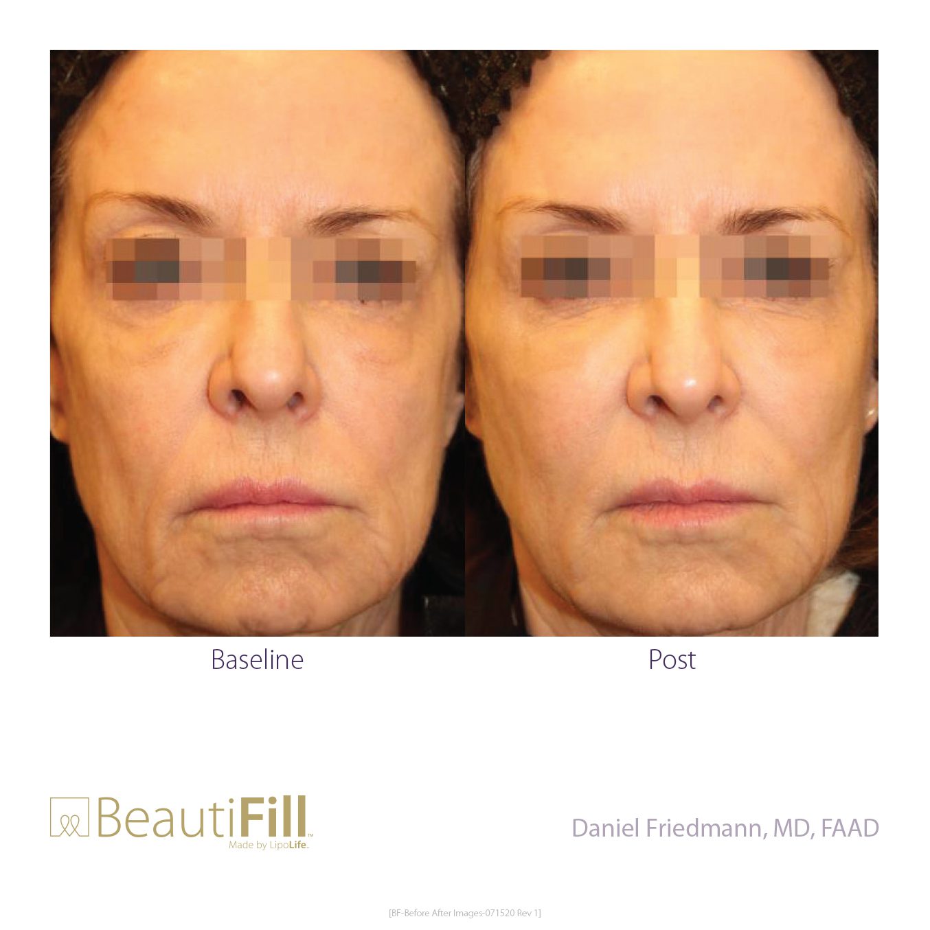 BeautiFill Before and After B2B 5