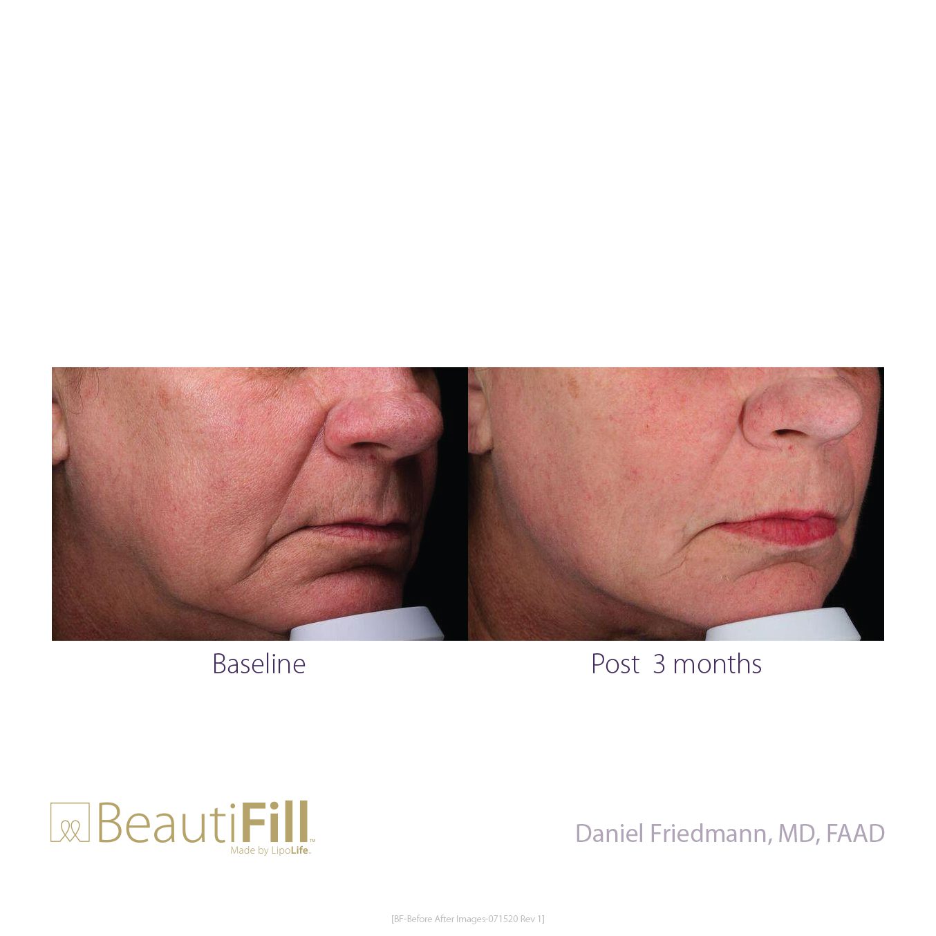 BeautiFill Before and After B2B 6