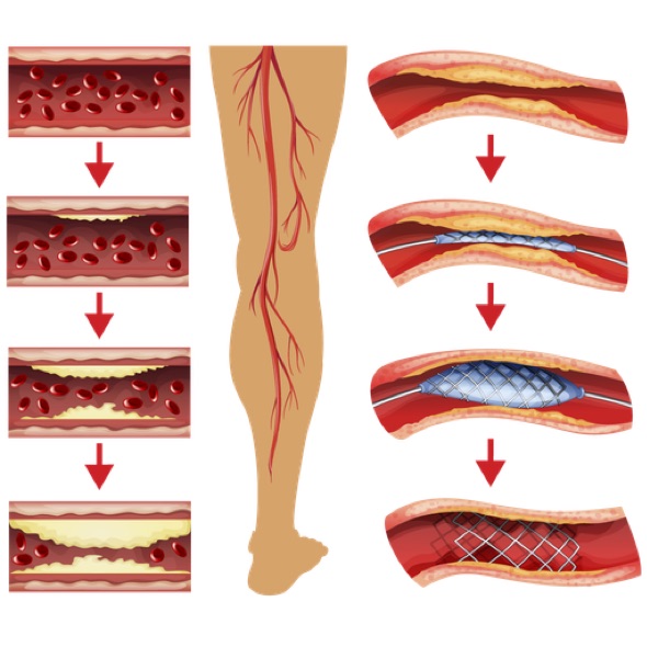 Ayur Interventional and Vascular Care PAD