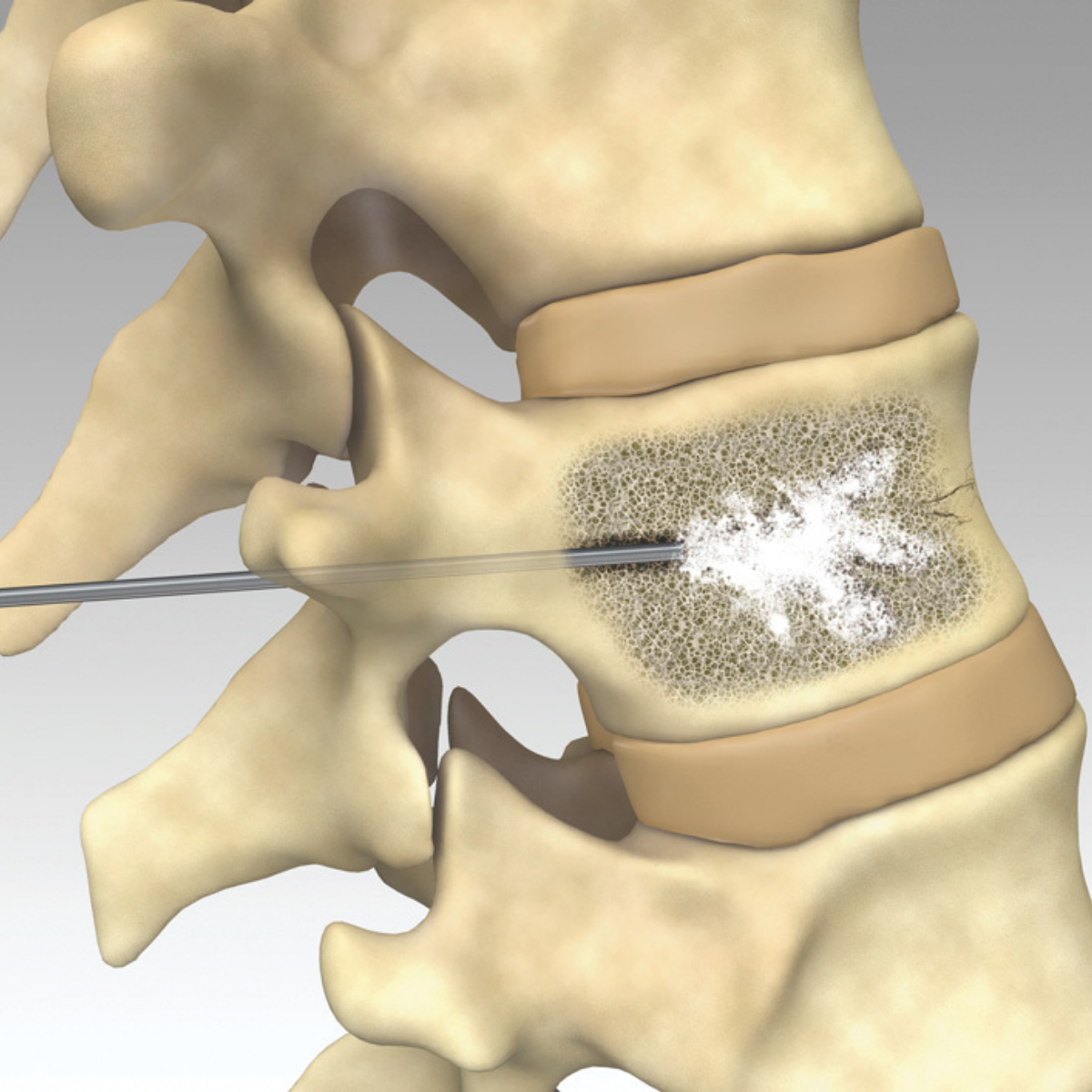 Ayur Interventional and Vascular Care Kyphoplasty