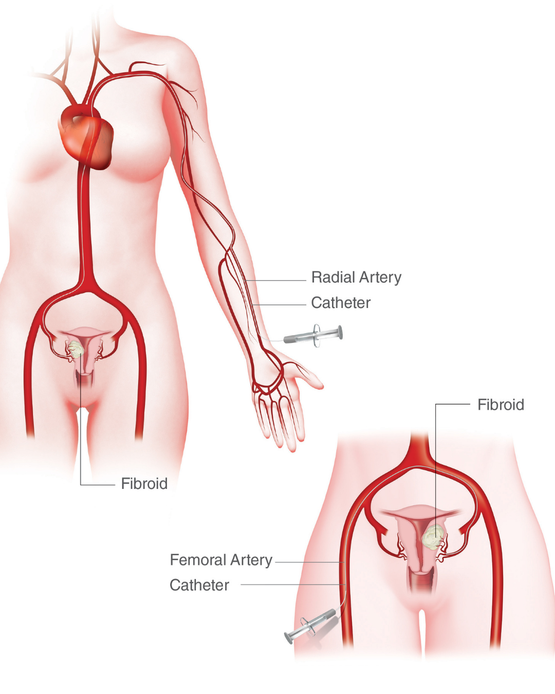 Ayur interventional and Vascular Care UFE Procedure