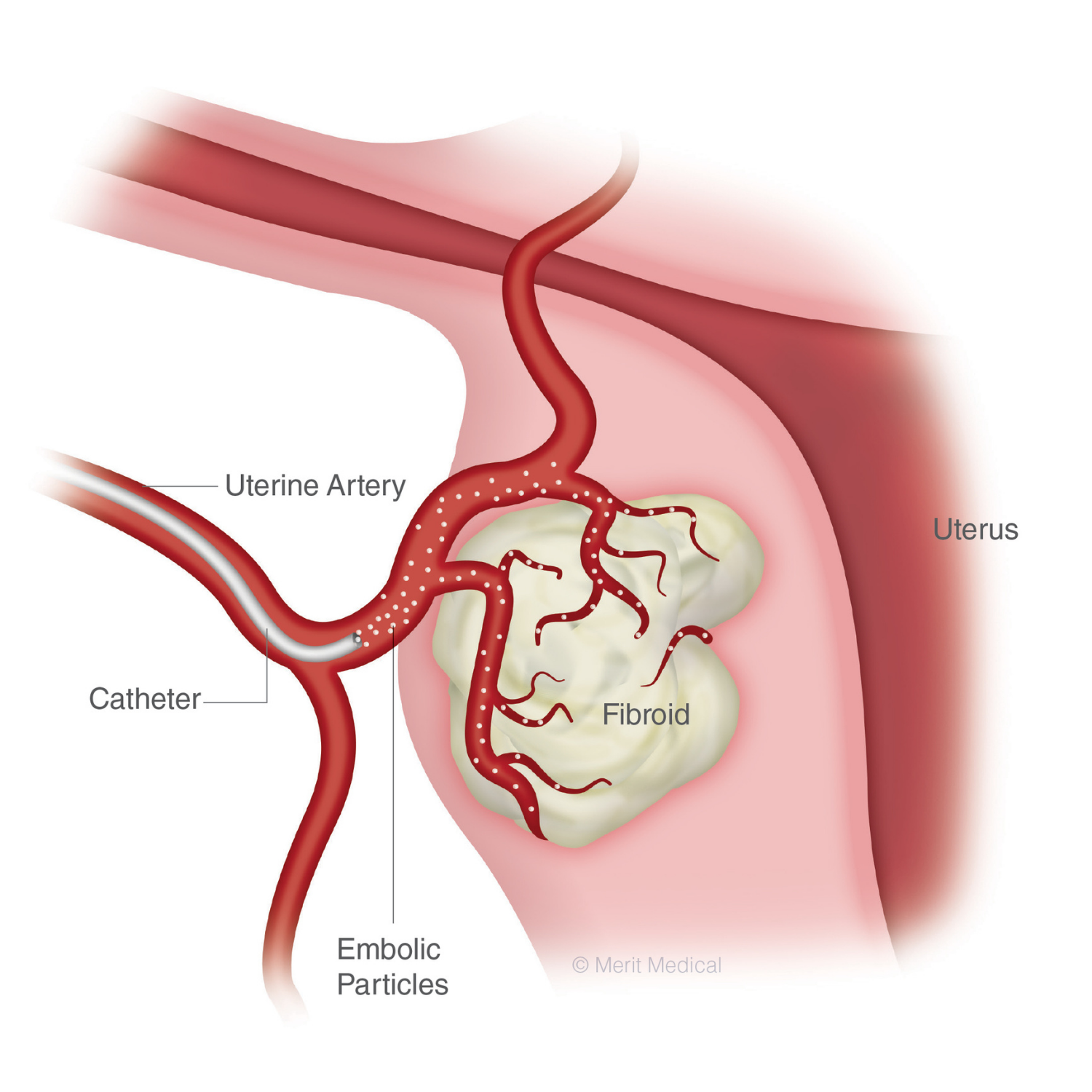 Uterine Fibroid Embolization